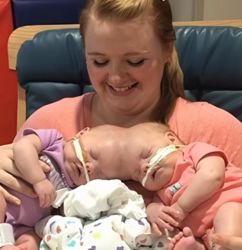 Birkaç yıl önce, kafalarından yapışık iki kız kardeş