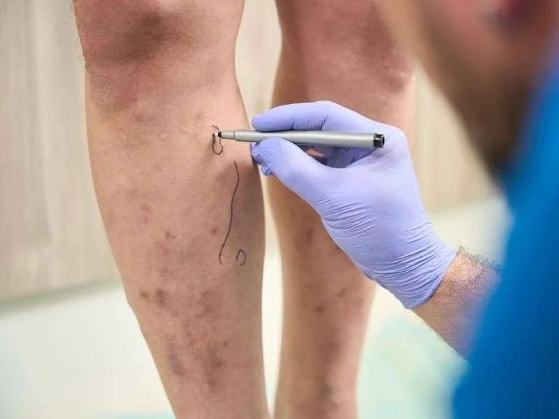 Varisli Damarlara Elveda Demenin Doğal