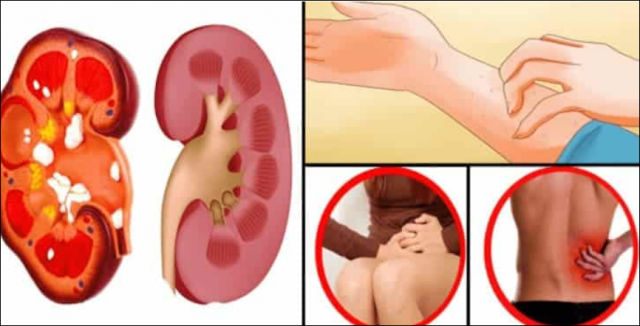Böbrek Kanserinin Bu Belirtilerine Dikkat