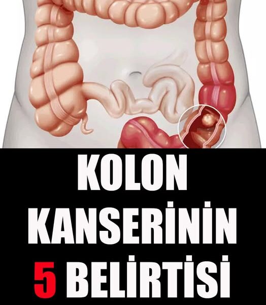 Kolon Kanserinin 5 Belirtisi