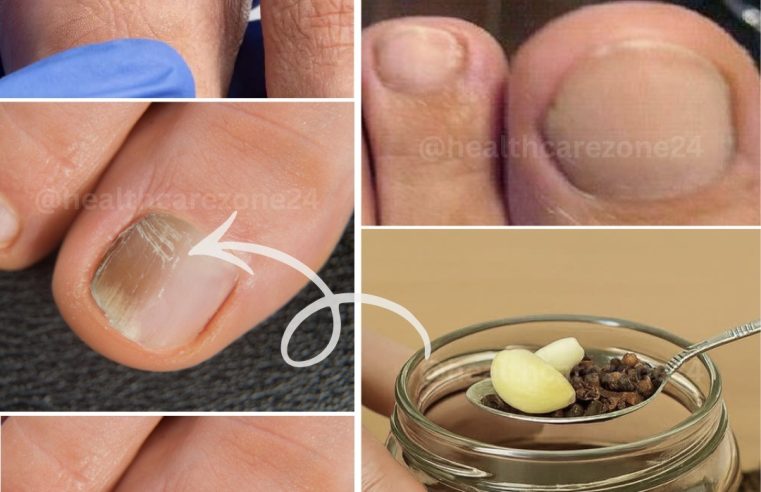 İnatçı mantara doğal yollarla veda edin