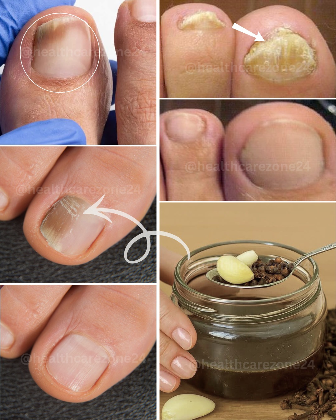 İnatçı mantara doğal yollarla veda edin