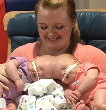 Yapışık ikizler karmaşık bir ameliyatın ardından ayrıldı