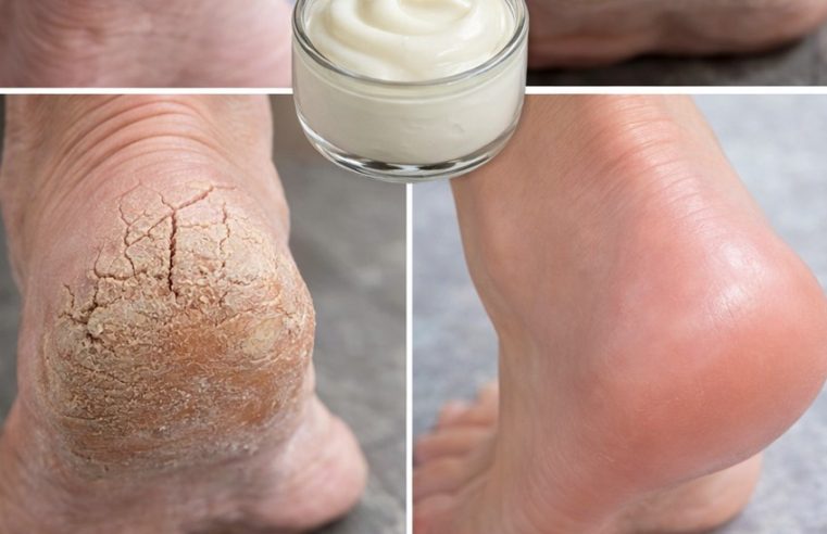 Çatlak topuklardan kurtulun