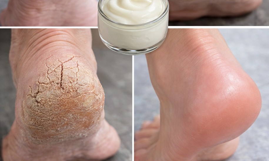 Çatlak topuklardan kurtulun