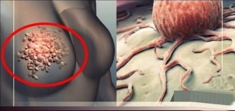 Meme kanserinin 7 sinyali.