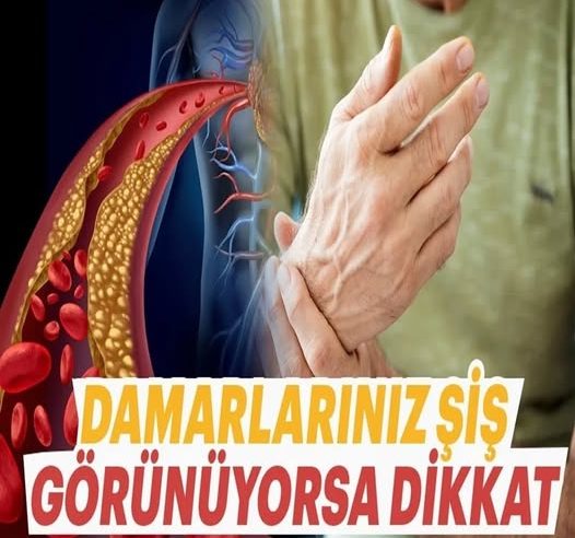 Görünür damarların varsa dikkat
