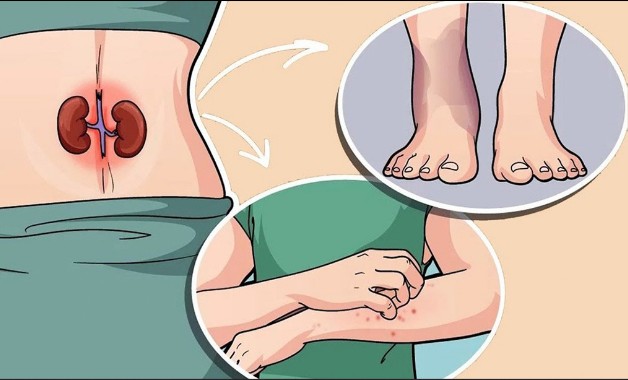 Böbrek Hastalığının 7 Belirtisi